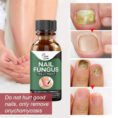 Nail Fungus Treatment - High Quality