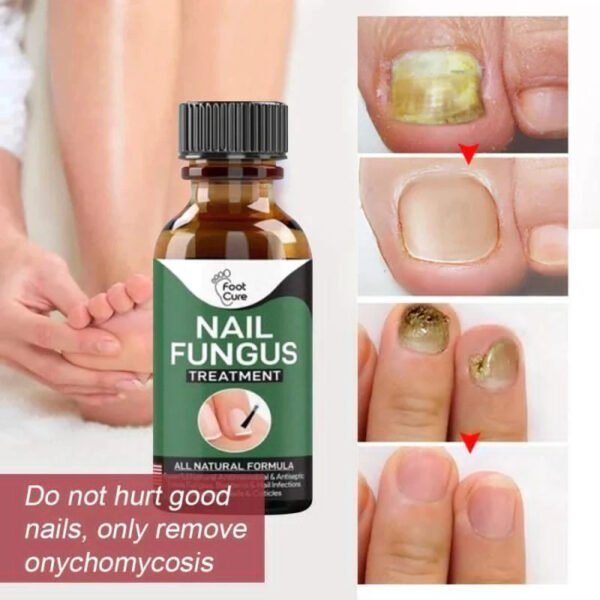 Nail Fungus Treatment - High Quality