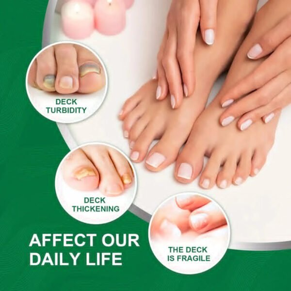 Nail Fungus Treatment - High Quality