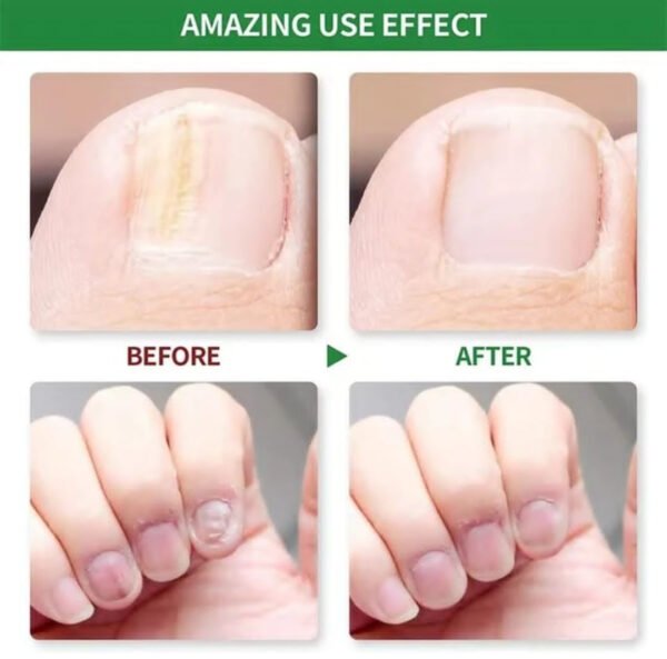 Nail Fungus Treatment - High Quality